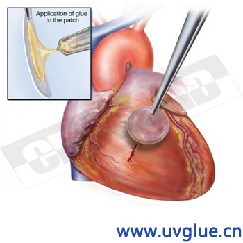 心脏修复2.jpg